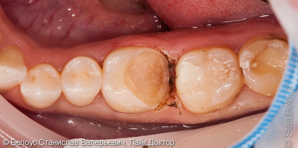 Установка Церек коронок на зубы за 4 часа - фото №4