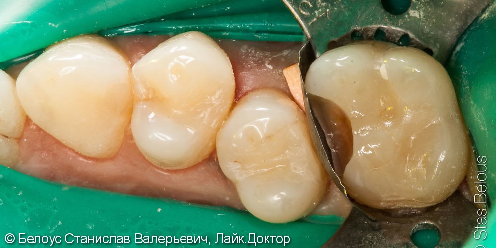 Лечение глубокого кариеса 16 зуба - фото №2