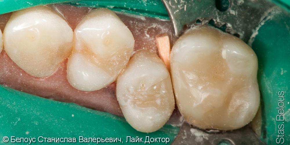 Лечение глубокого кариеса 16 зуба - фото №3
