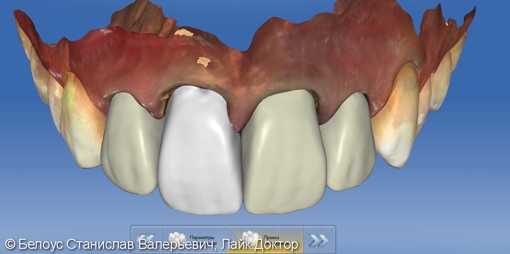 Установка коронок на передние зубы верхние резцы Cad/cam CEREC - фото №6