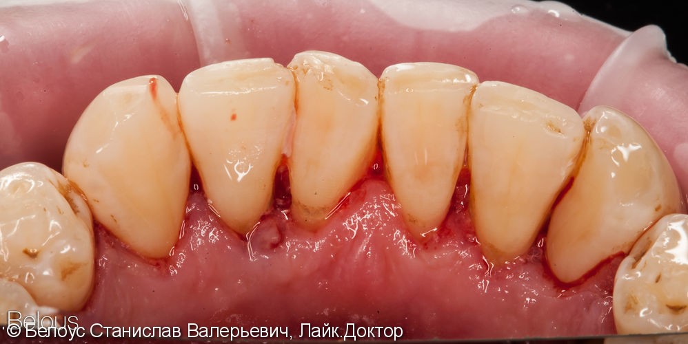 Профессиональная гигиена, удаление зубных камней - фото №2