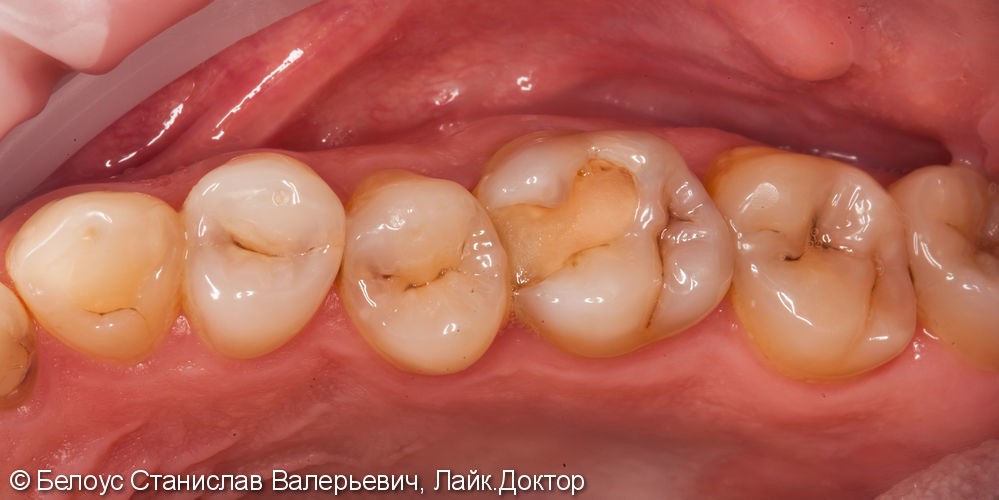 Лечение кариеса 3 зуба сразу - фото №1