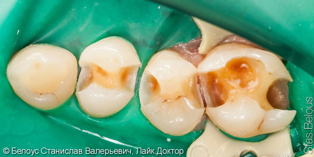 Лечение кариеса 3 зуба сразу - фото №2