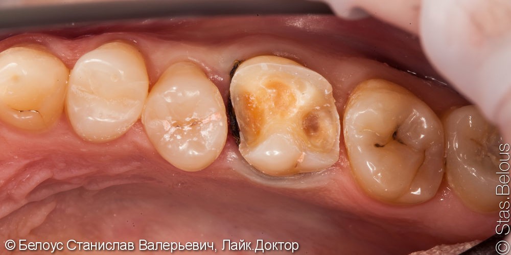 Лечение кариеса 3 зуба сразу - фото №3