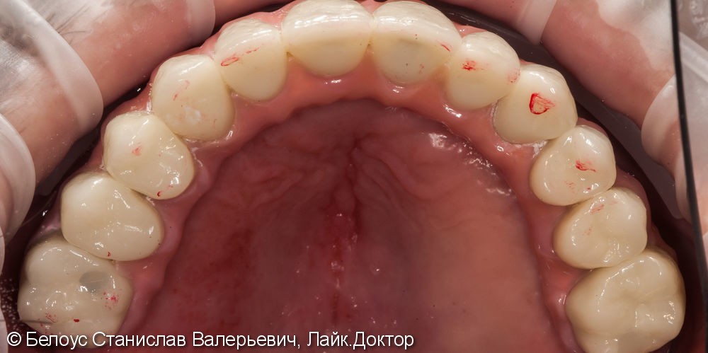 Зубной протез с опорой на 4 импланта Straumann (Германия) - фото №3