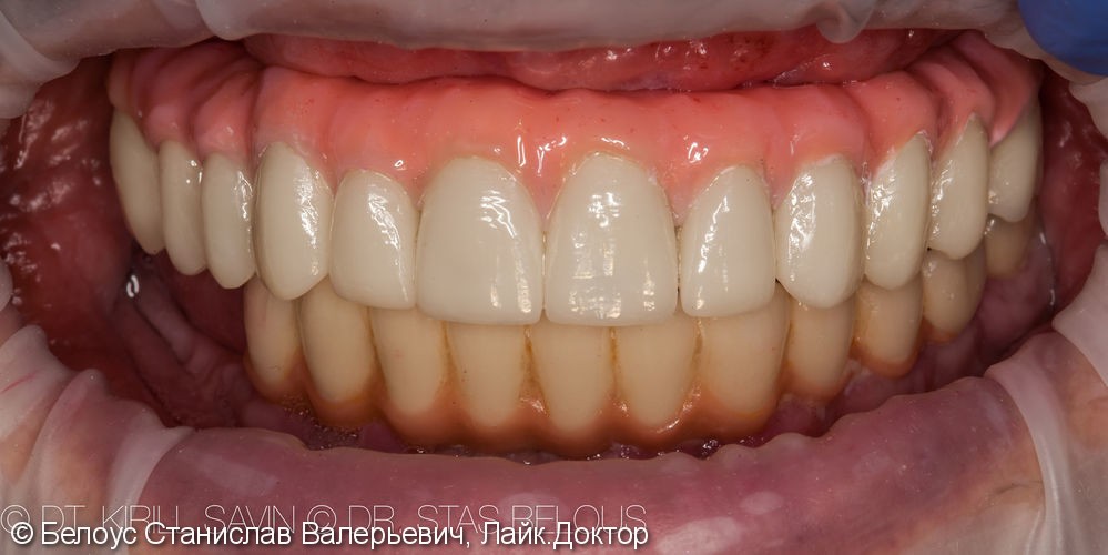 Зубной протез с опорой на 4 импланта Straumann (Германия) - фото №4