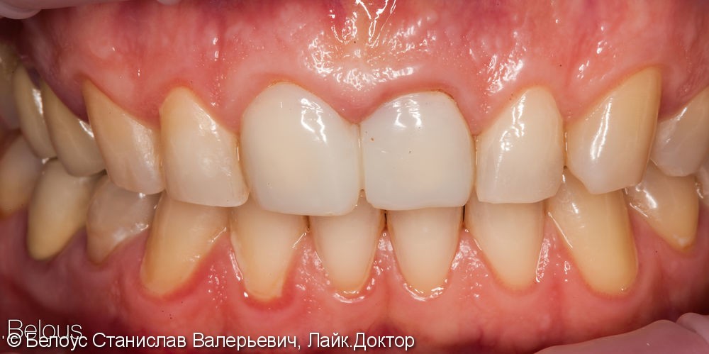 Передние зубы за 1 визит CEREC - фото №1