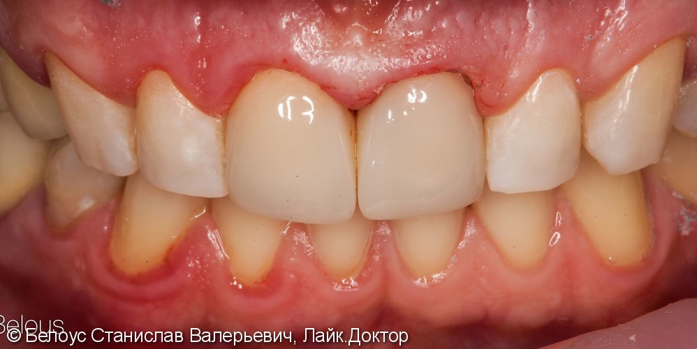 Передние зубы за 1 визит CEREC - фото №4