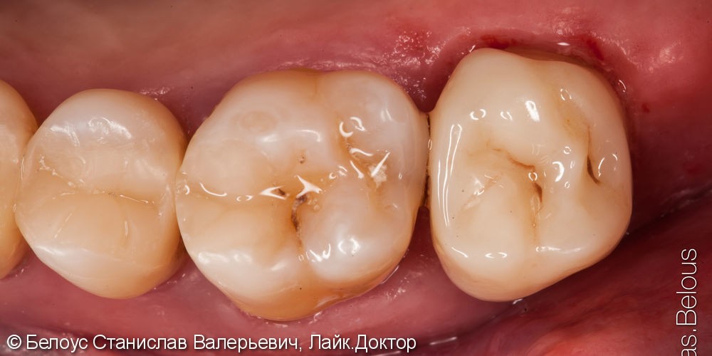 Лечение глубокого кариеса 27 зуба - фото №8