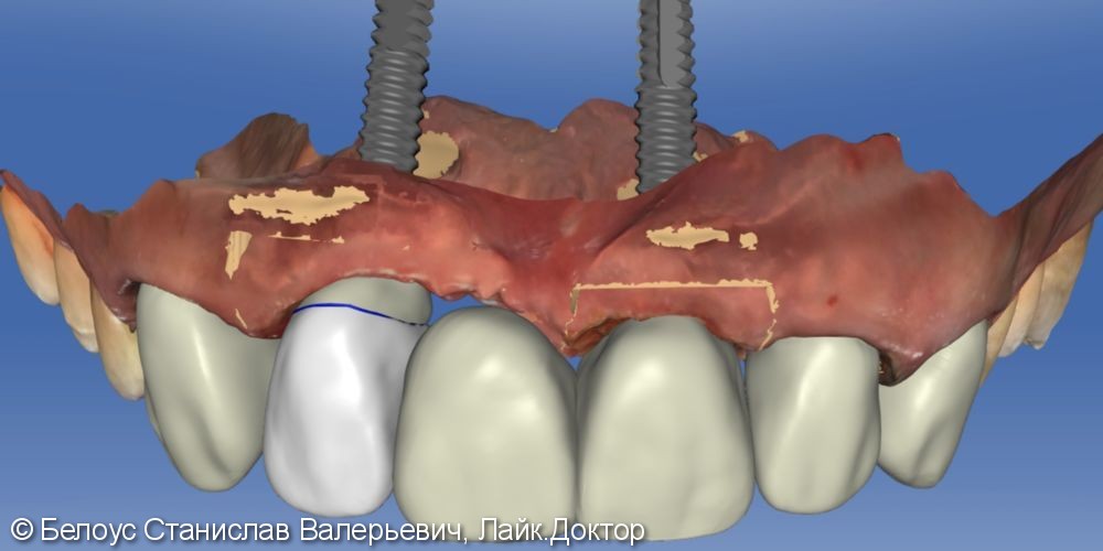 Протезирование на имплантах по CAD/CAM - фото №5