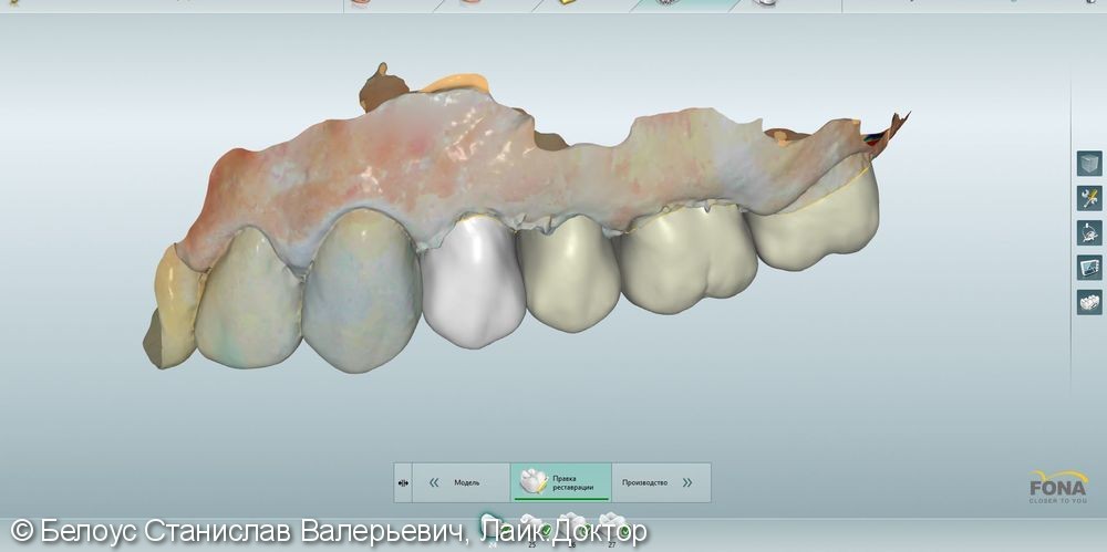 Лечение периодонтита и постановка коронок CEREC - фото №2