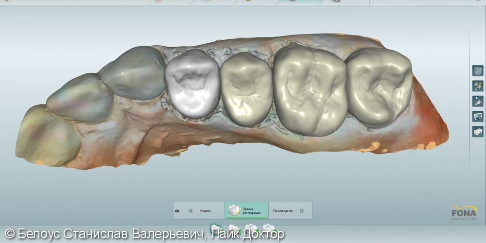 Лечение периодонтита и постановка коронок CEREC - фото №3