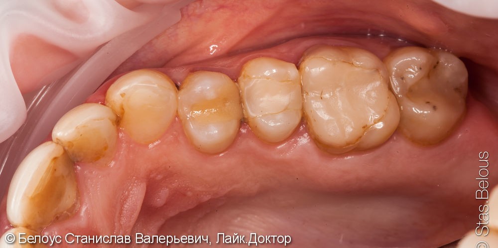 Лечение зубов с микроскопом и постановка CEREC коронок - фото №1