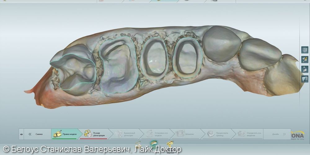 Лечение зубов с микроскопом и постановка CEREC коронок - фото №2