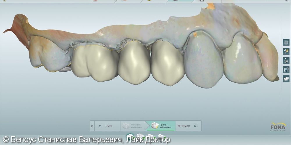 Лечение зубов с микроскопом и постановка CEREC коронок - фото №3