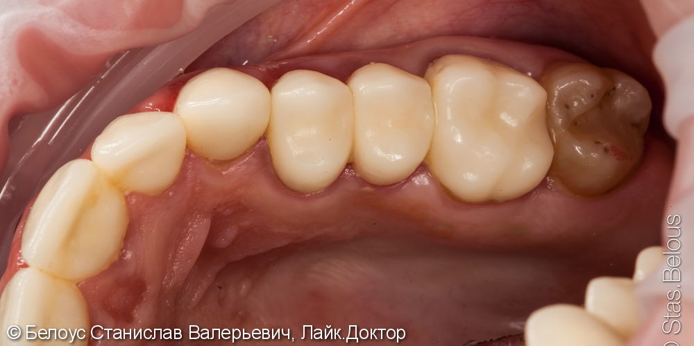 Лечение зубов с микроскопом и постановка CEREC коронок - фото №4