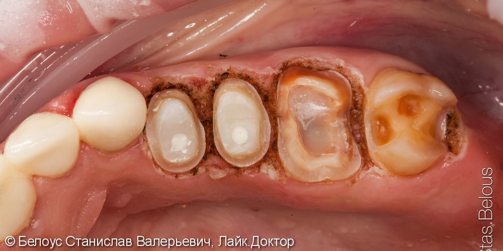Лечение зубов с микроскопом и постановка CEREC коронок - фото №5