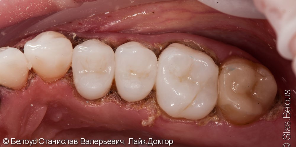 Лечение зубов с микроскопом и постановка CEREC коронок - фото №6
