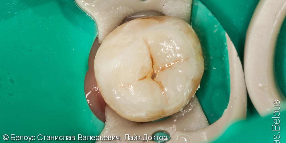 Лечение глубокого кариеса 8 нижнего зуба постановкой керамической вкладки по технологии CEREC - фото №6