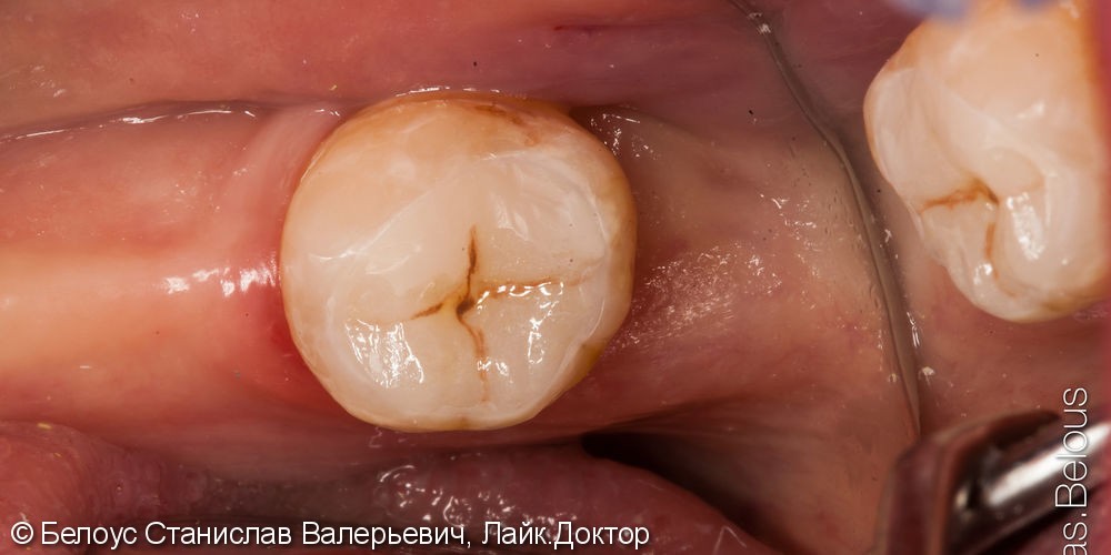 Лечение глубокого кариеса 8 нижнего зуба постановкой керамической вкладки по технологии CEREC - фото №8