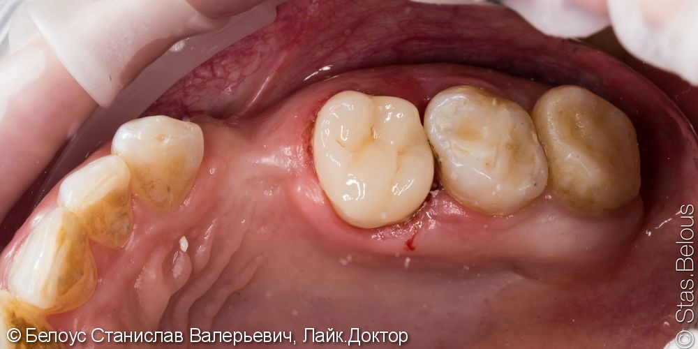 Лечение каналов и установка коронки на 16 зуб - фото №4