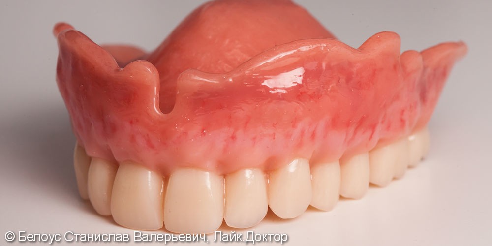 Съемные зубные протезы - фото №1