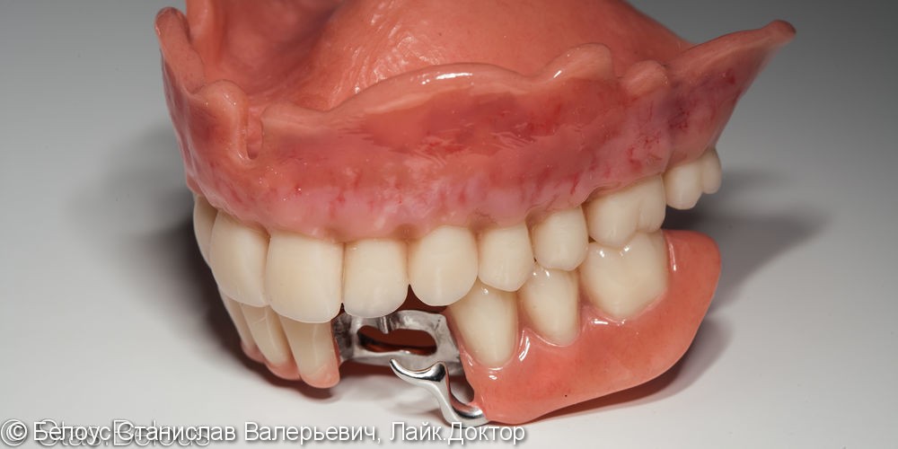Съемные зубные протезы - фото №2