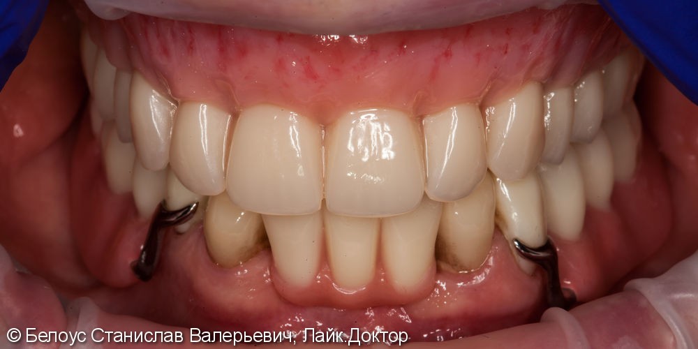 Съемные зубные протезы - фото №3