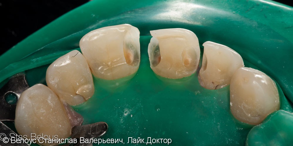 Лечение кариеса на передних зубах. ХУДОЖЕСТВЕННАЯ реставрация - фото №2