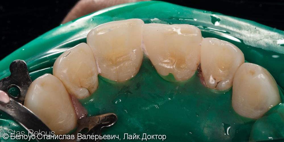 Лечение кариеса на передних зубах. ХУДОЖЕСТВЕННАЯ реставрация - фото №3