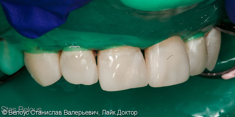 Лечение кариеса на передних зубах. ХУДОЖЕСТВЕННАЯ реставрация - фото №4