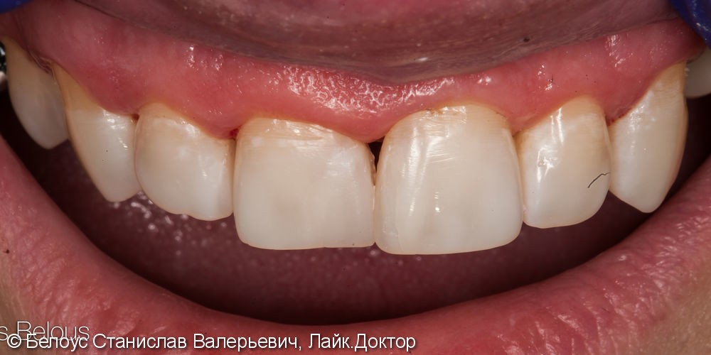 Лечение кариеса на передних зубах. ХУДОЖЕСТВЕННАЯ реставрация - фото №5