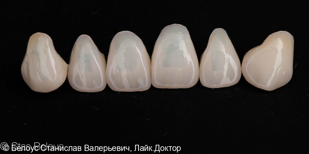 Коронки CEREC на передние зубы - фото №4