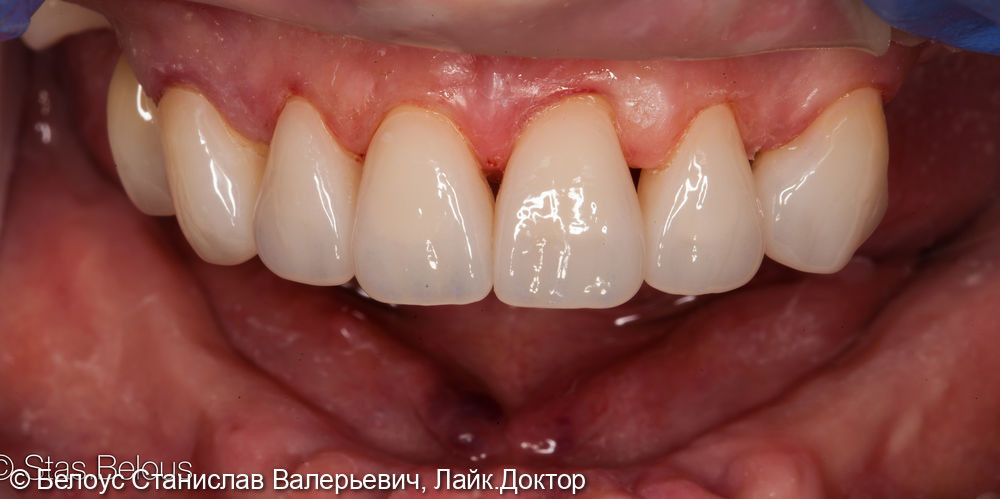 Коронки CEREC на передние зубы - фото №5