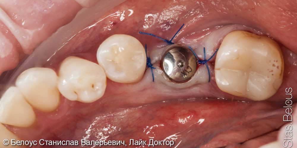 Имплант вместо удаленного зуба - фото №2