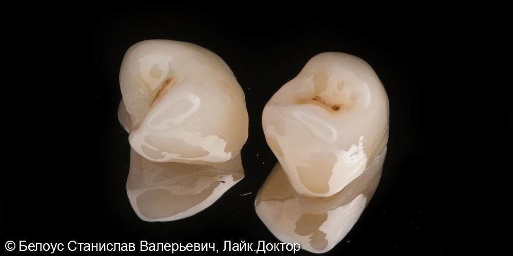 Коронки на Боковые зубы - фото №2