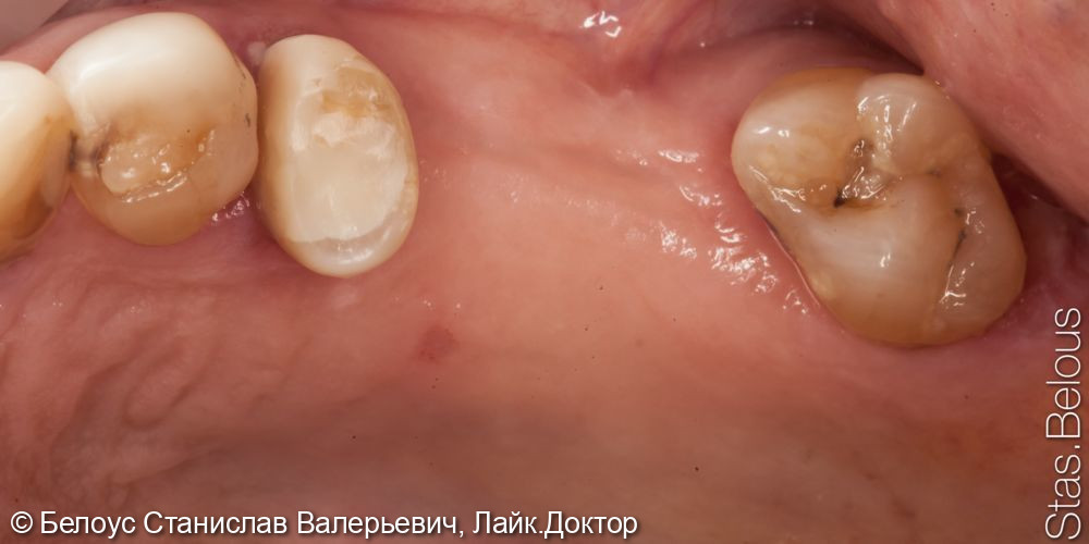 Лечение зуба установкой коронки CEREC - фото №1