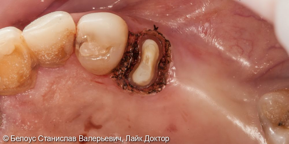 Лечение зуба установкой коронки CEREC - фото №2