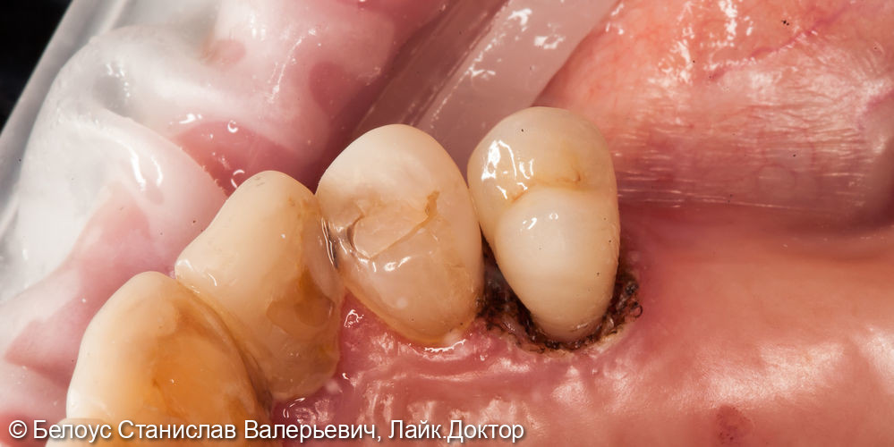 Лечение зуба установкой коронки CEREC - фото №4