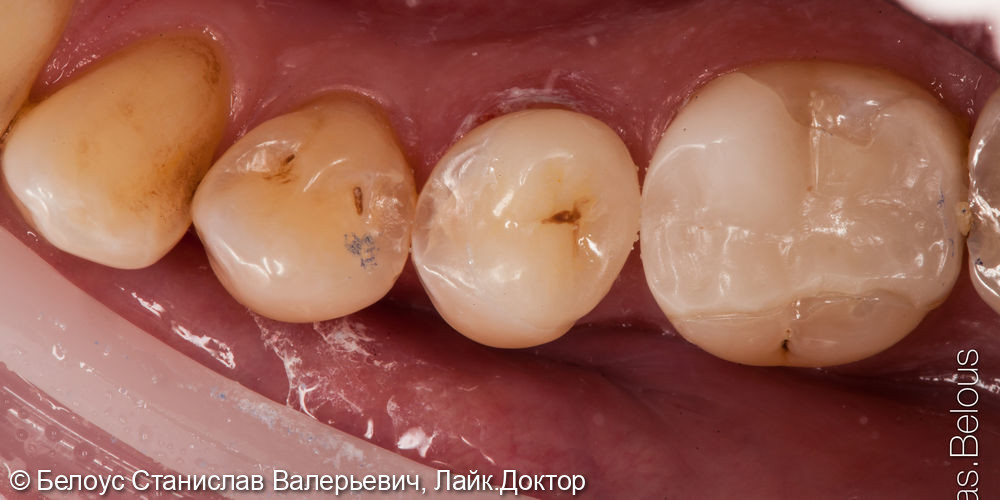 Установка полукоронки на зуб CEREC - фото №3
