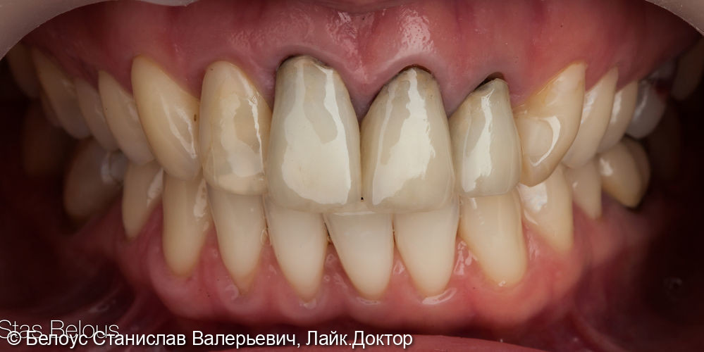 Временные коронки из пластмассы на передние зубы - фото №1