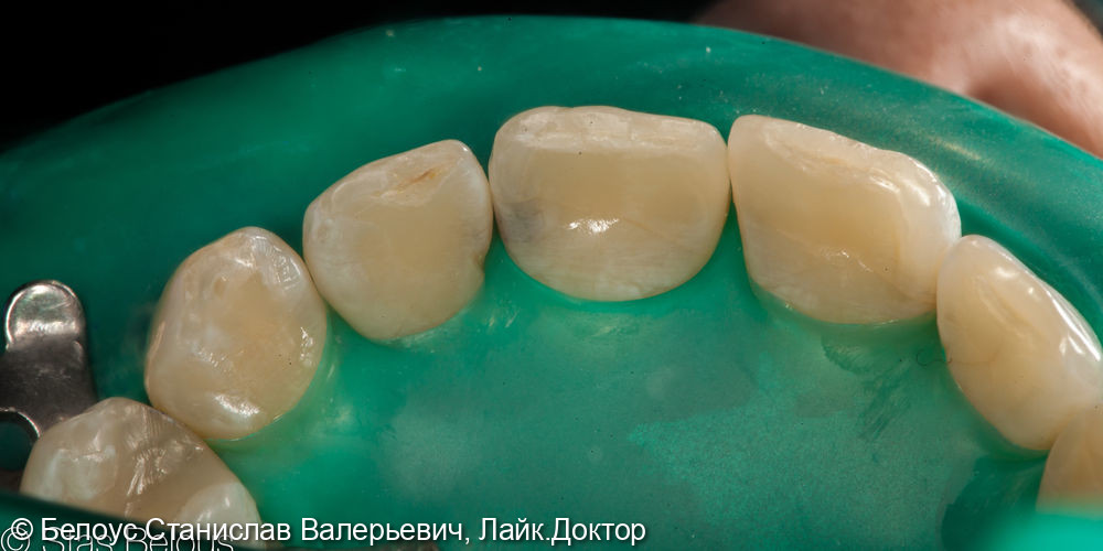 Лечение кариеса на передних зубах - фото №1