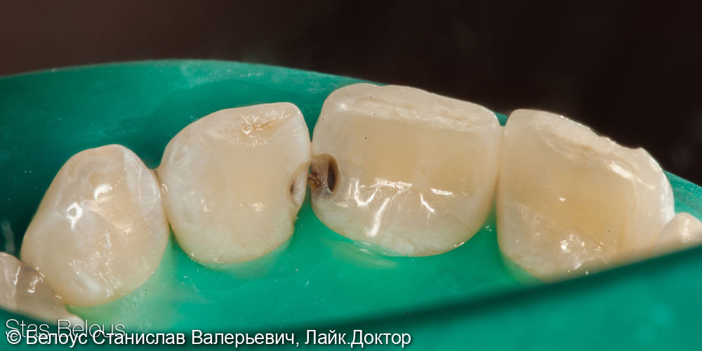 Лечение кариеса на передних зубах - фото №2