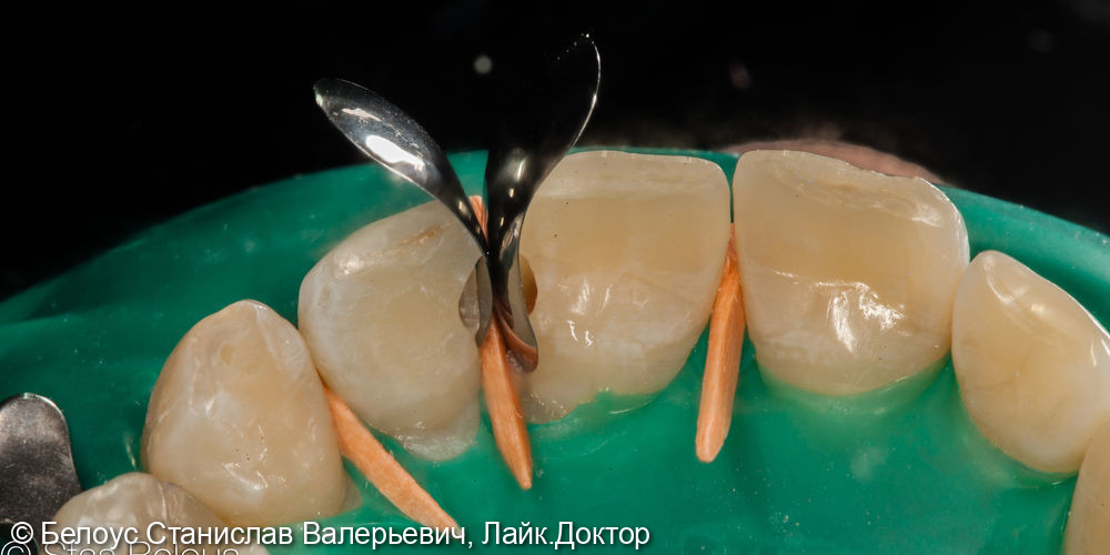 Лечение кариеса на передних зубах - фото №3