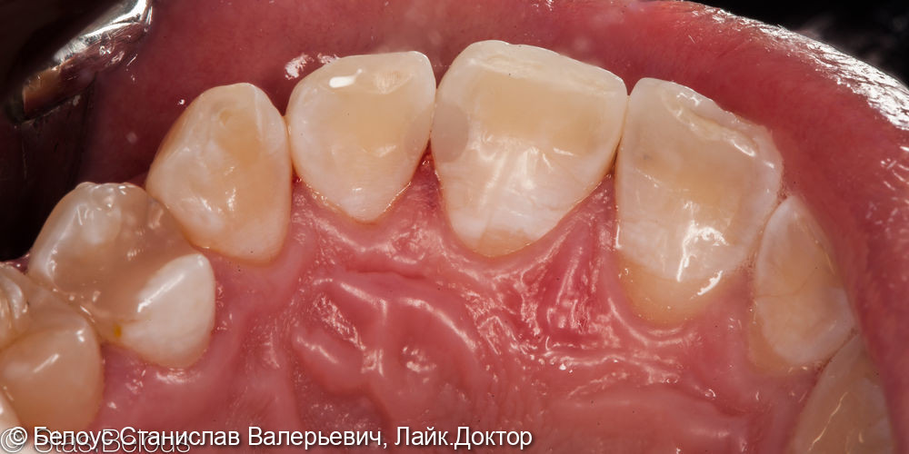Лечение кариеса на передних зубах - фото №4