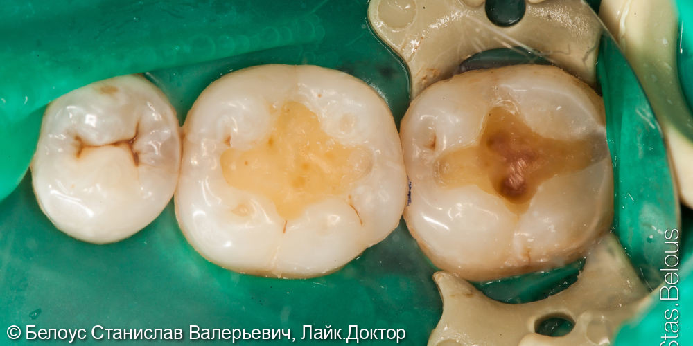 Лечение кариеса композитными реставрациями пломбами - фото №2