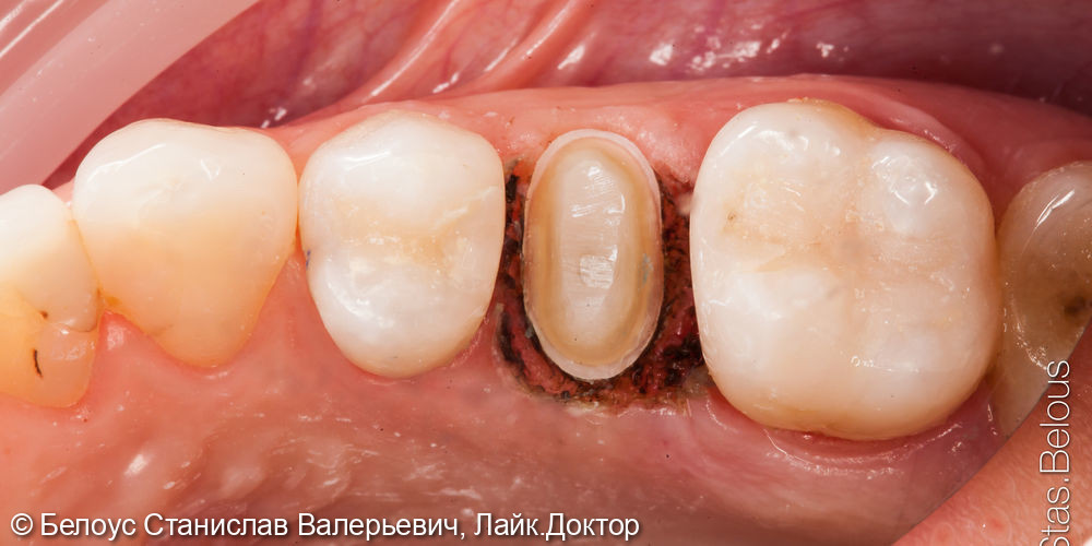 Спасение зуба, лечение периодонтита и временная коронка - фото №2
