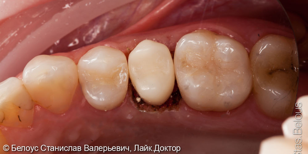 Спасение зуба, лечение периодонтита и временная коронка - фото №3