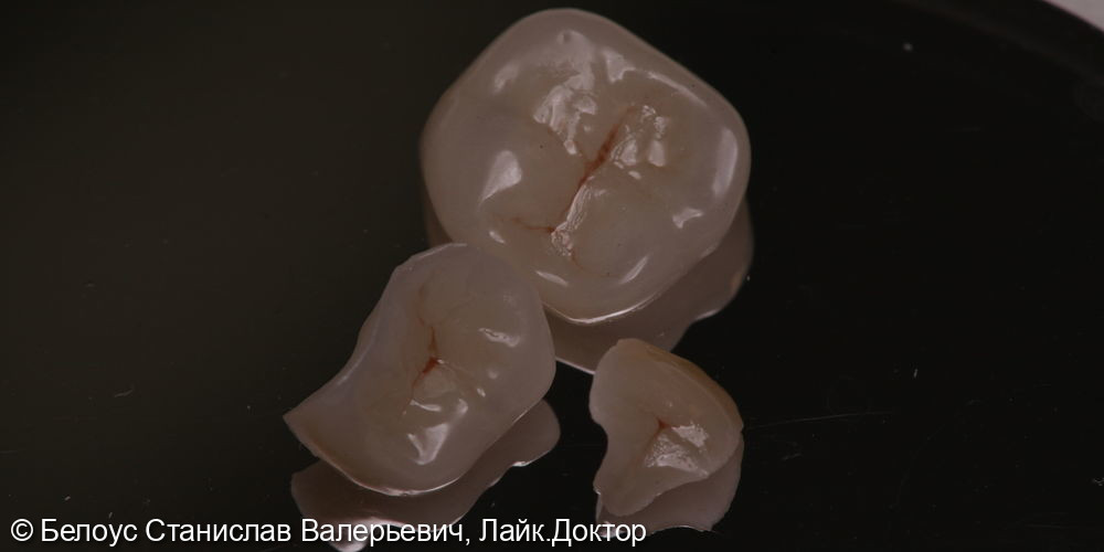 Восстановление зубов керамическими вкладками CEREC - фото №3