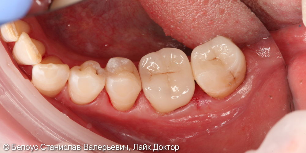 Восстановление зубов керамическими вкладками CEREC - фото №4